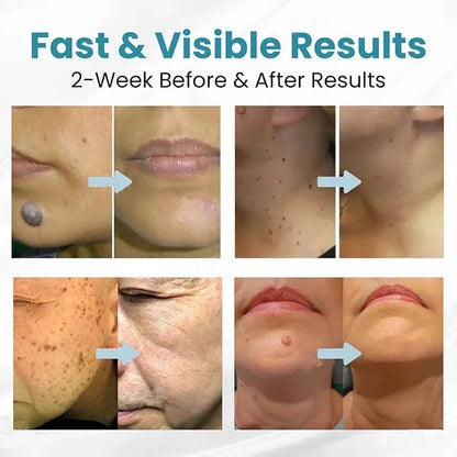 Xorita pen for cosmetic skin blemish care - visible results over time